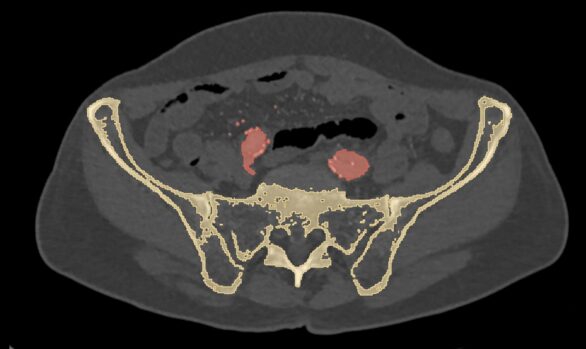 Medical Image Segmentation