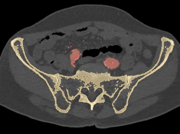 Medical Image Segmentation